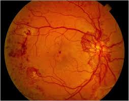 Diabetic Retinopathy